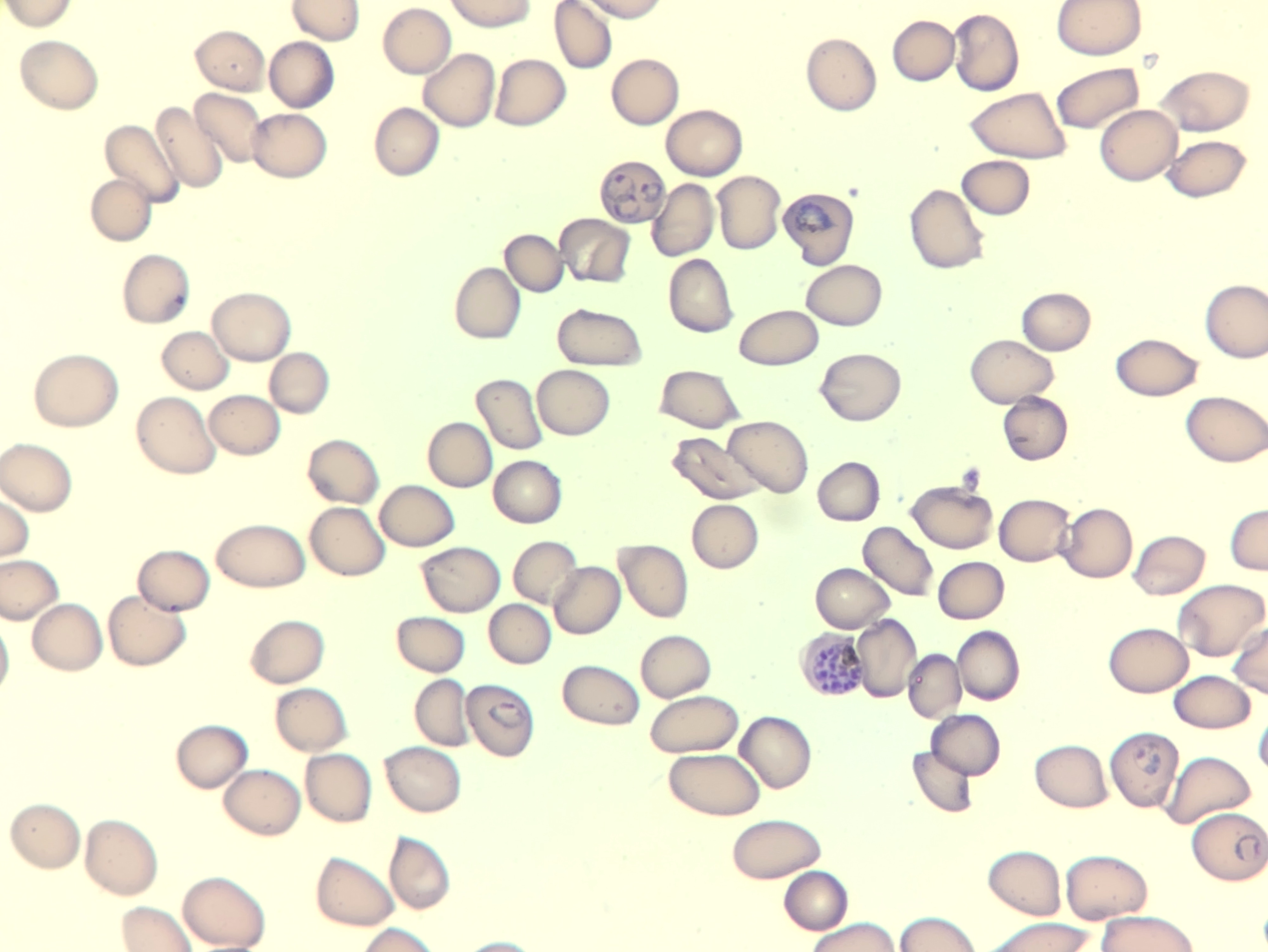 Discovery of Critical Iron-Transport Protein in Malaria Parasites Could ...